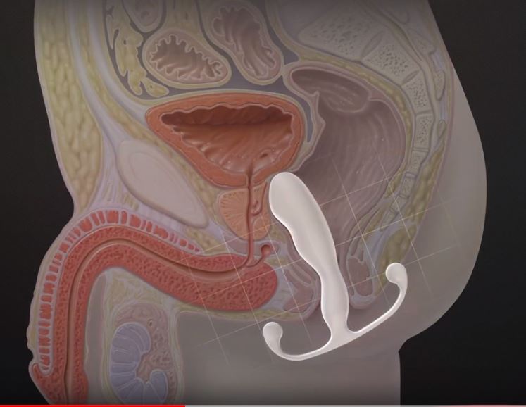 Anatomische dwarsdoorsnede toont Helix Trident gepositioneerd tegen de prostaat